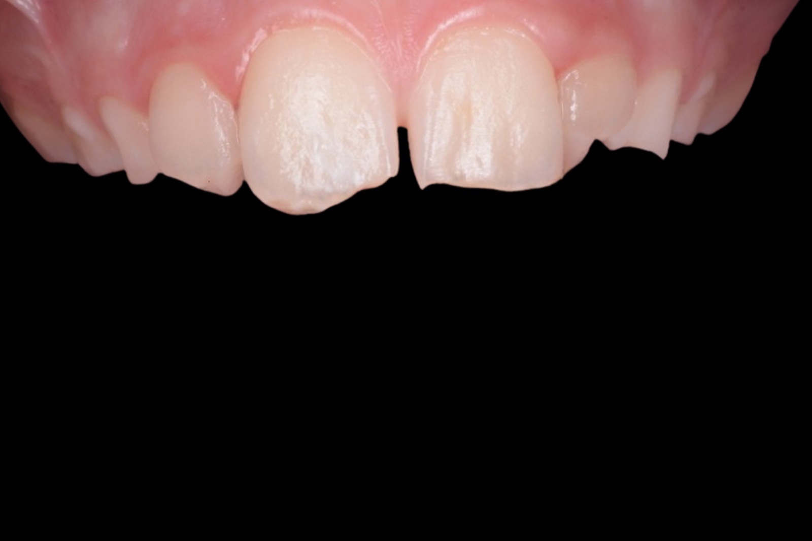 Cracked or Broken Teeth