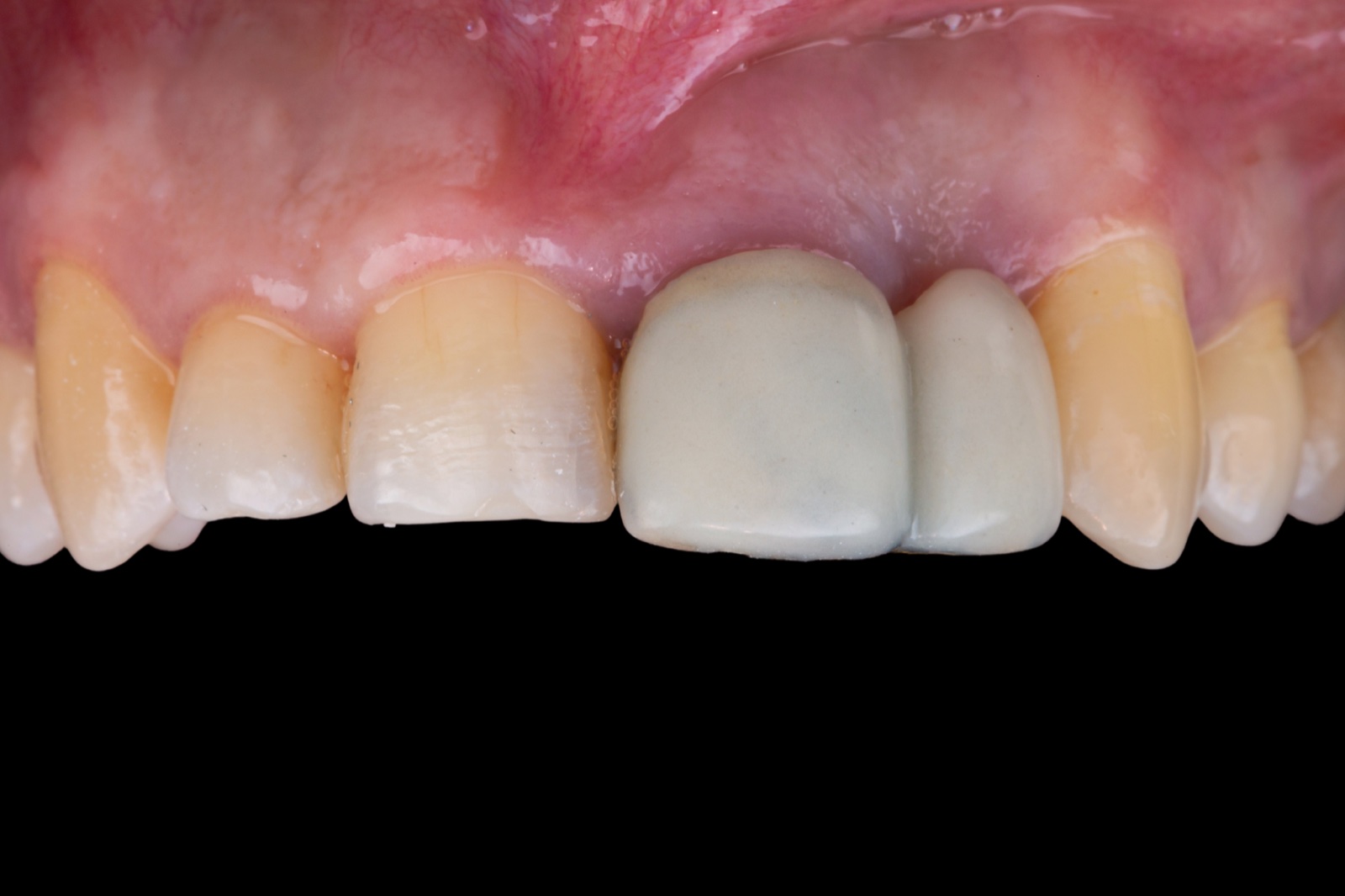 Failed Dental Work
