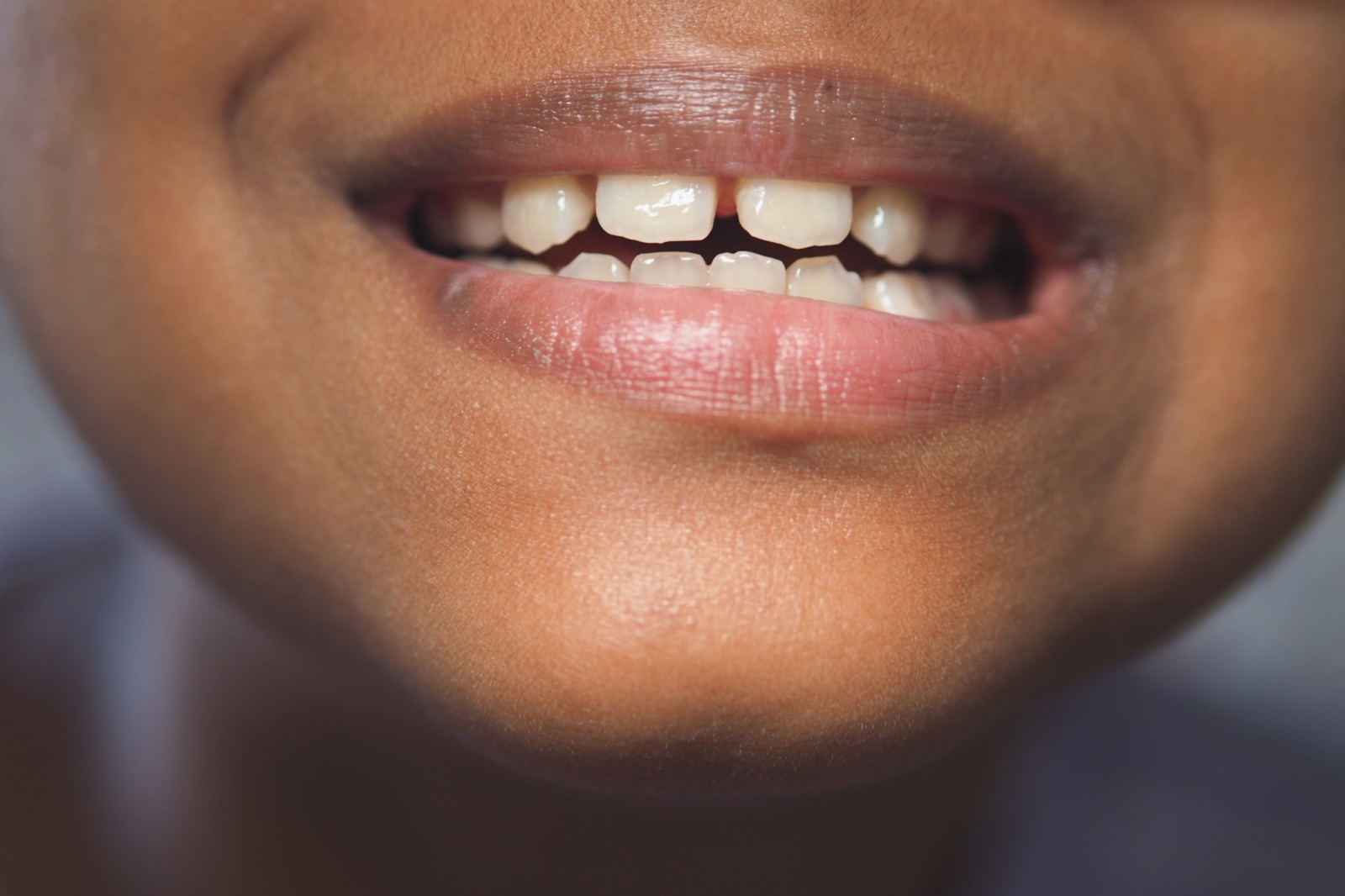 Gaps Between Teeth