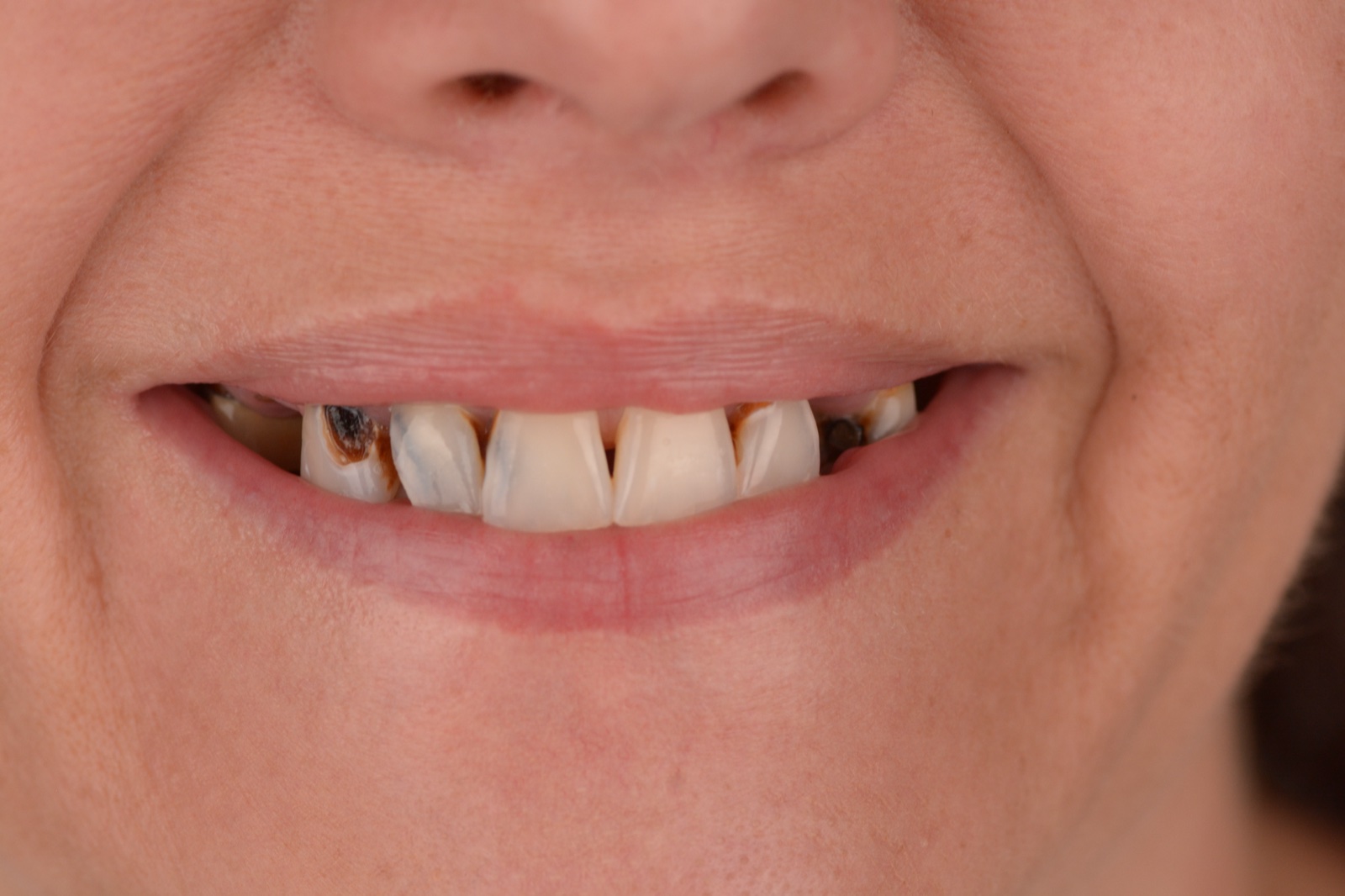 Multiple Missing Teeth