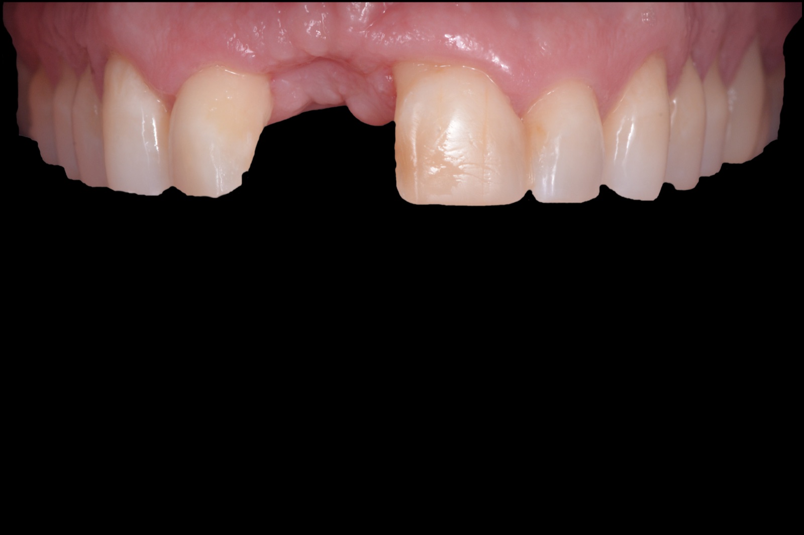 Missing Teeth solutions