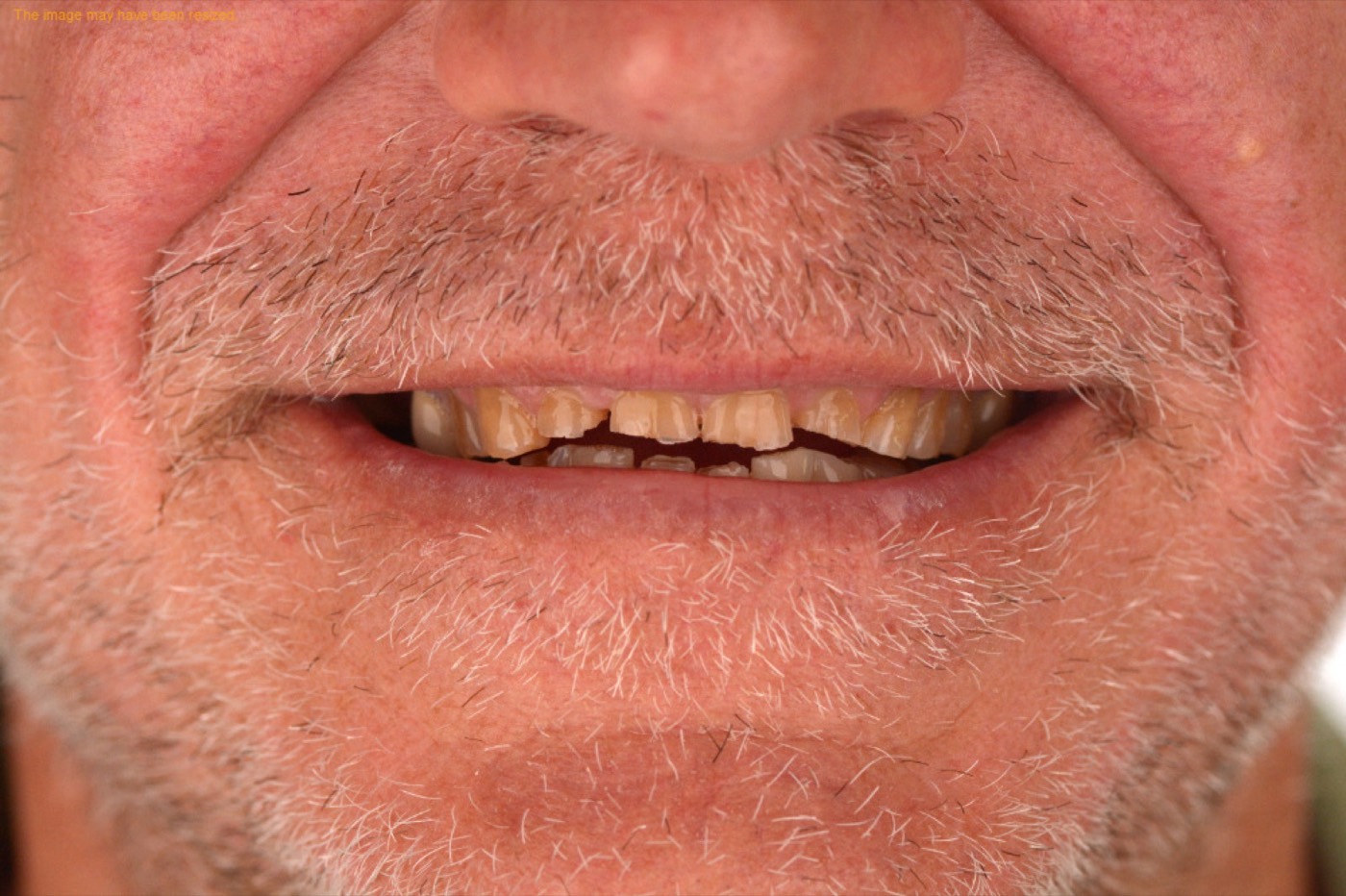 Tooth Damage and Wear solutions