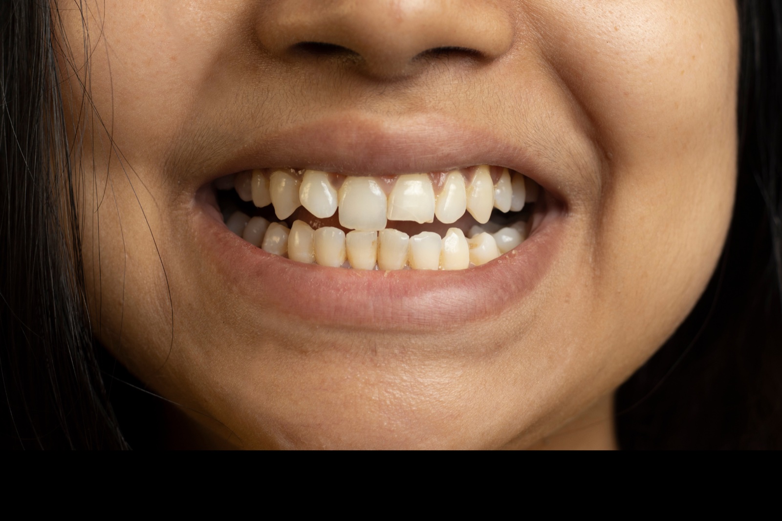 Uneven or Crooked Smile