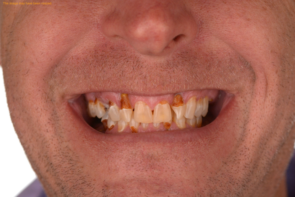 Full Smile result, before