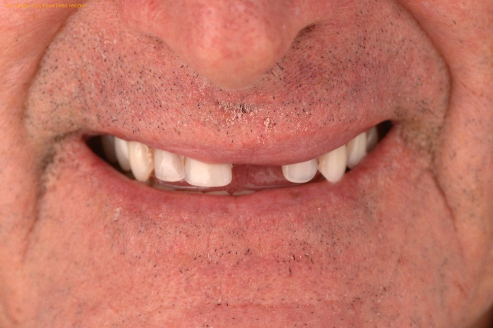 Full Smile result, before