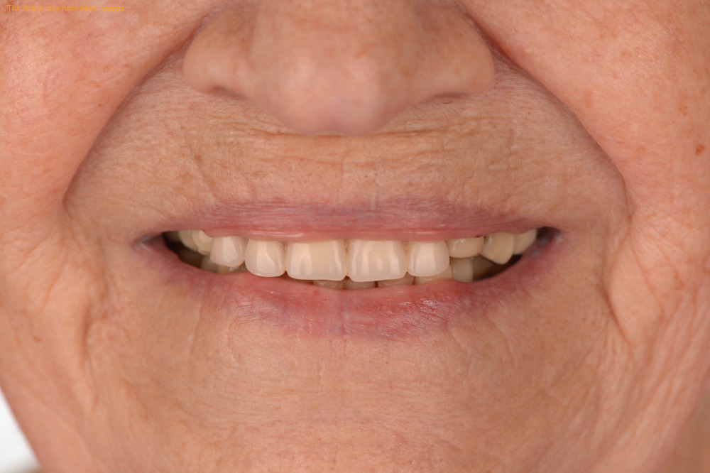 Full Smile case 05, after