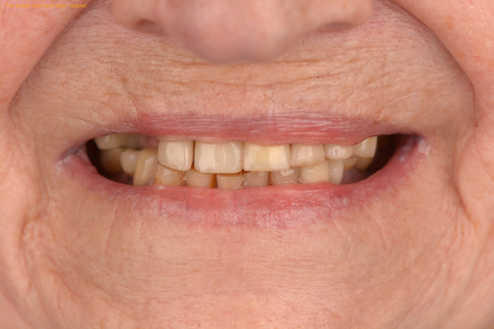 Full Smile case 05, before