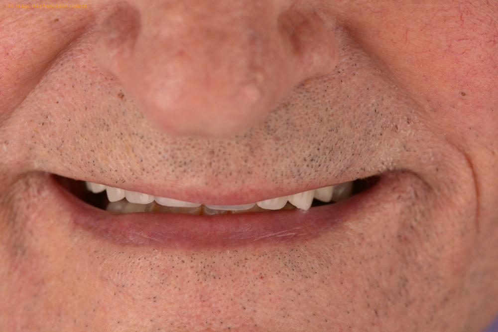 Full Smile result, before