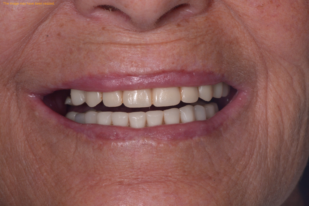 Full Smile case 09, before