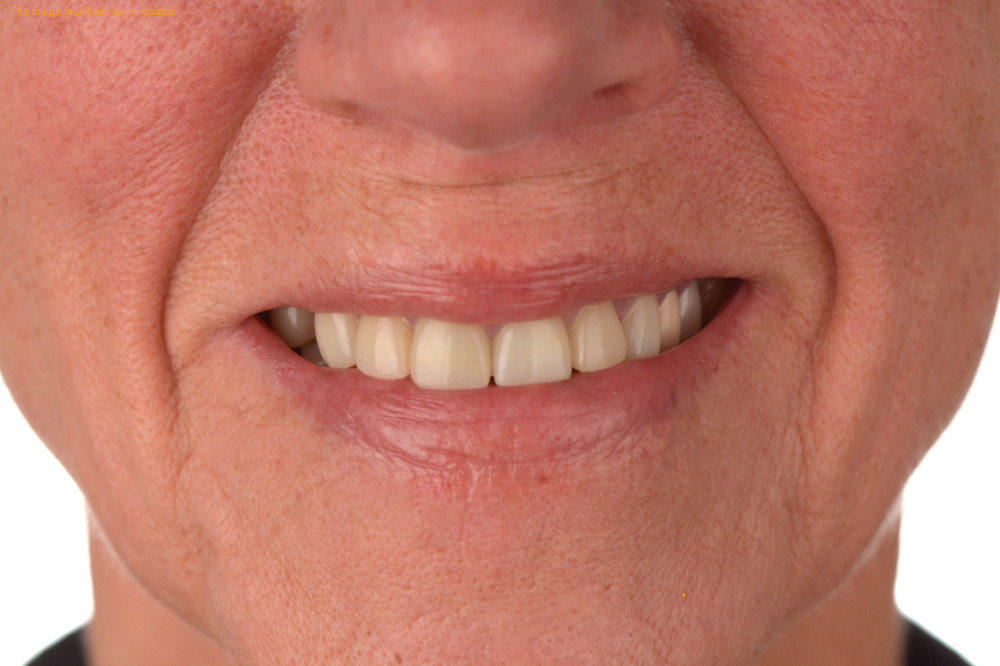 Full Smile case 14, before