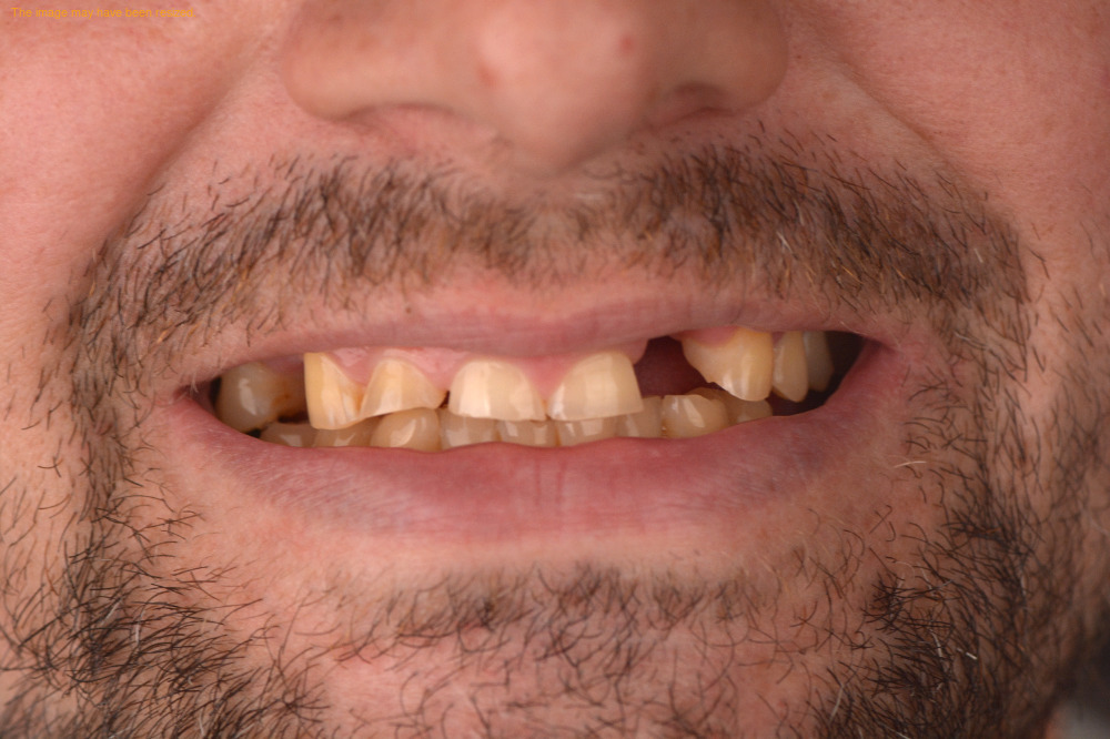 Full Smile case 15, before