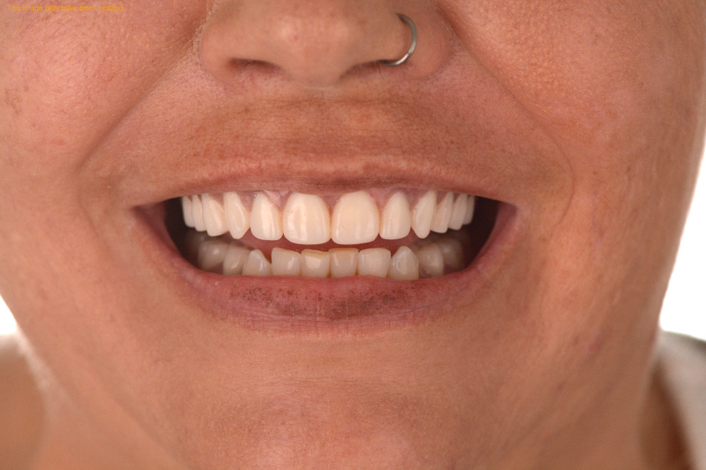 Implants case 07, after