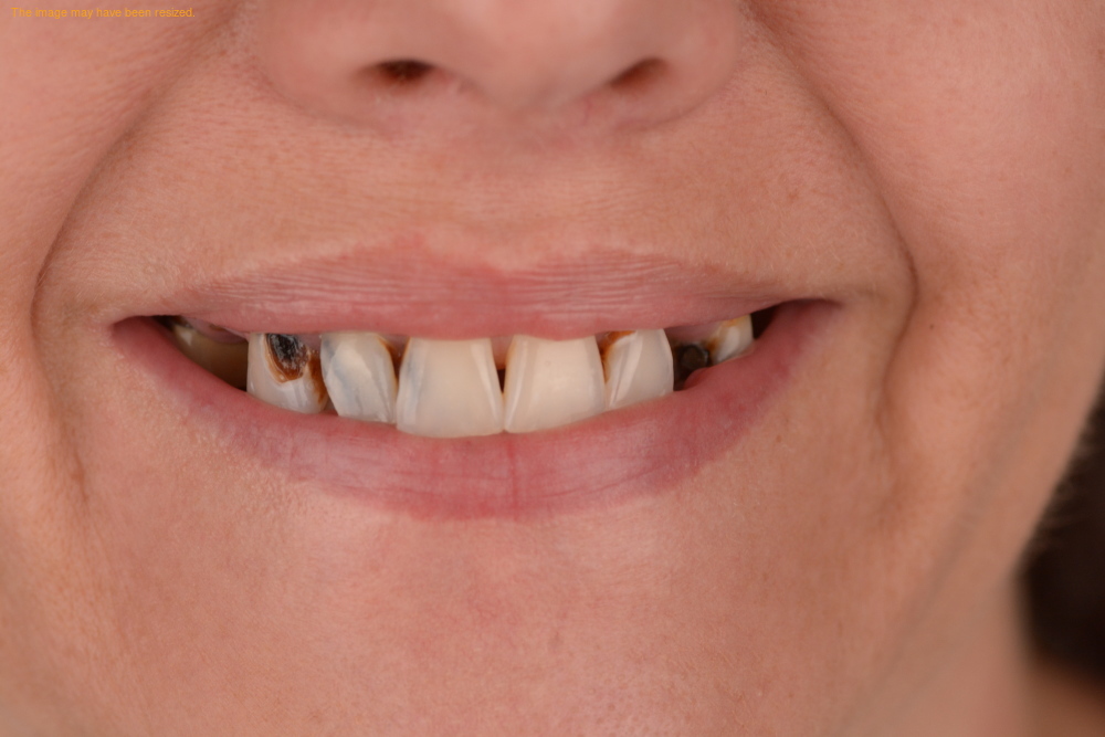 Implants case 10, before