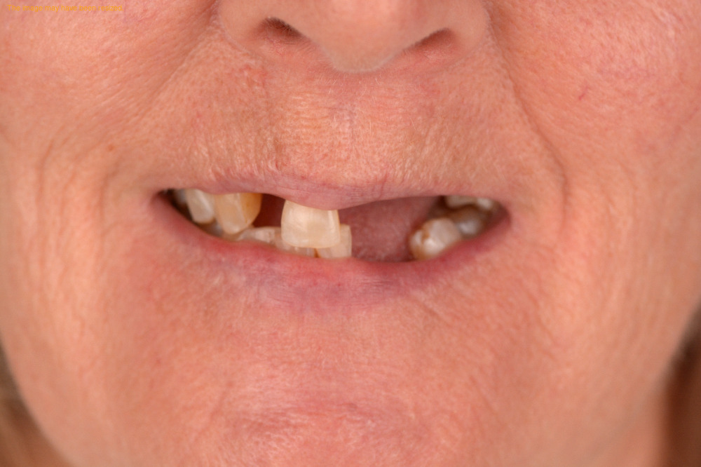 Implants case 11, before