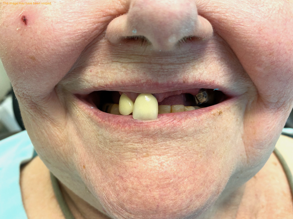 Implants case 12, before