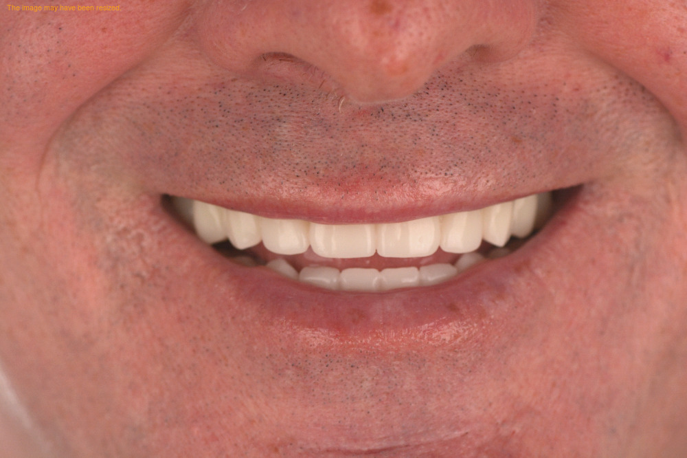 Implants case 14, after