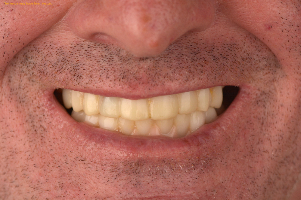 Implants case 14, before