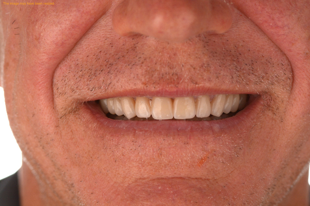 Implants case 16, after