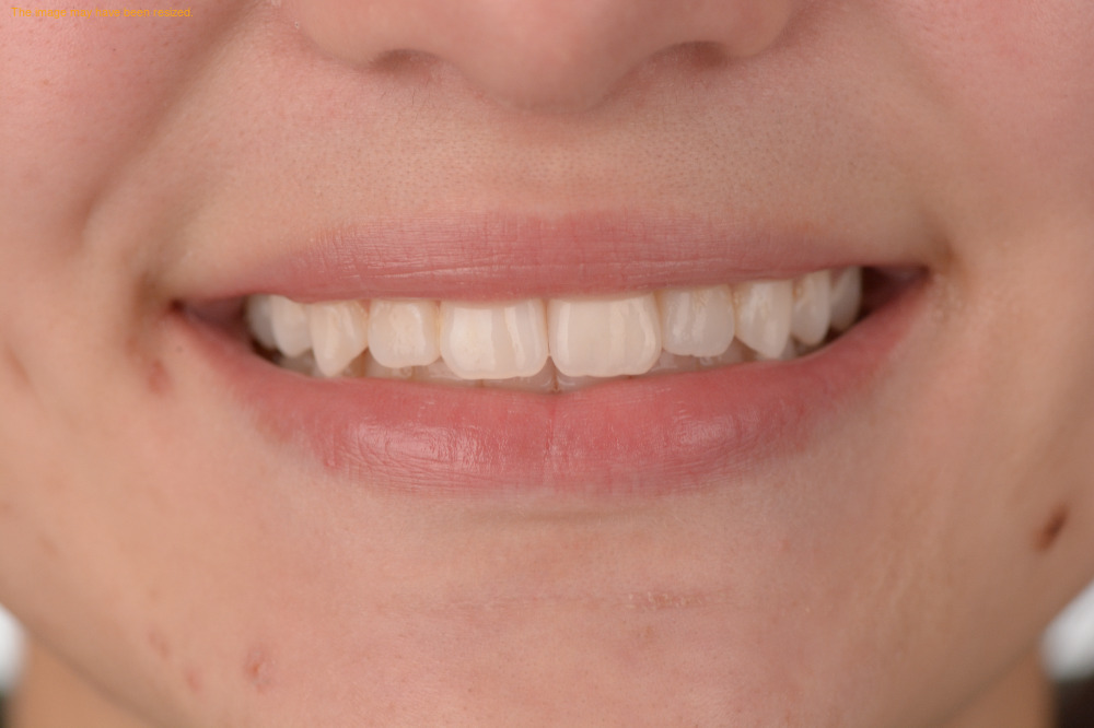 Restorations result, after