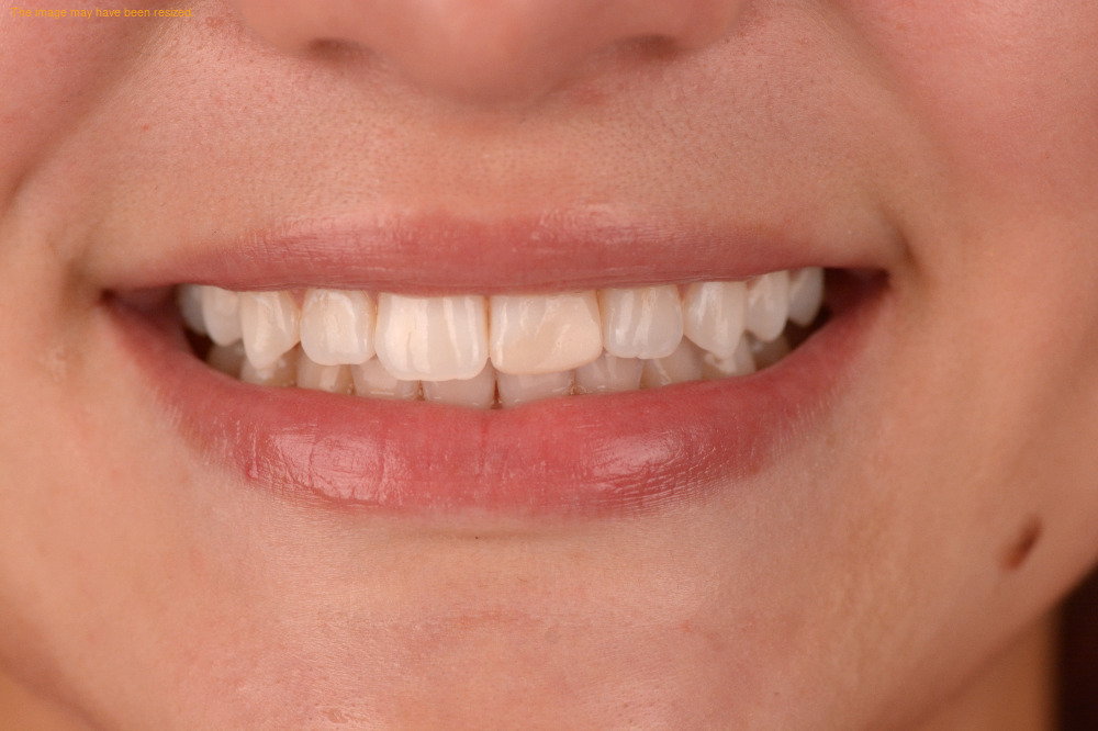 Restorations result, before