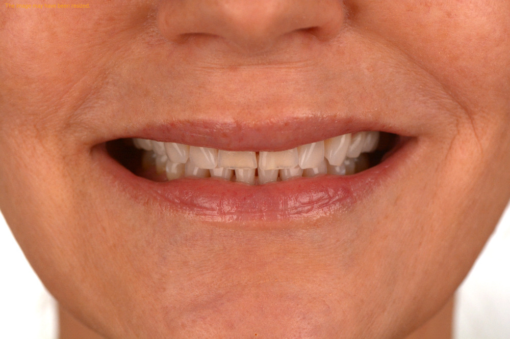 Restorations result, before