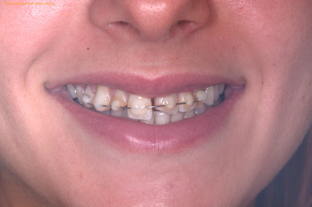 Restorations result, before