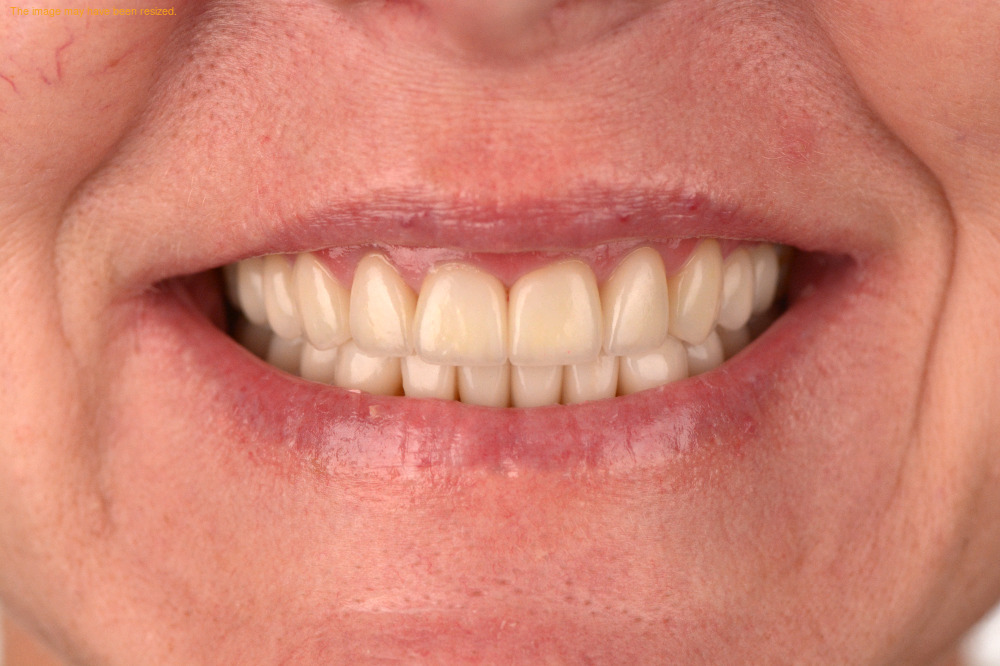 Restorations result, after