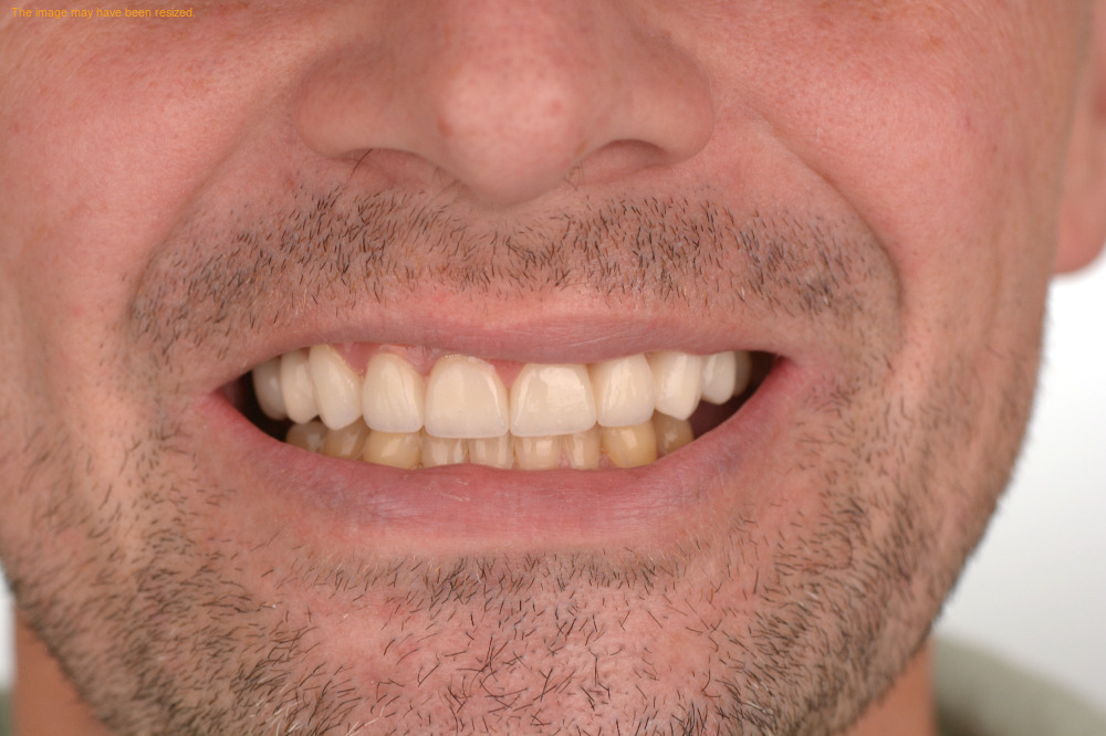 Restorations result, after