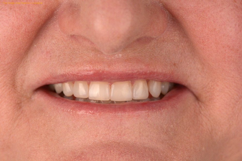 Smile Makeovers result, after
