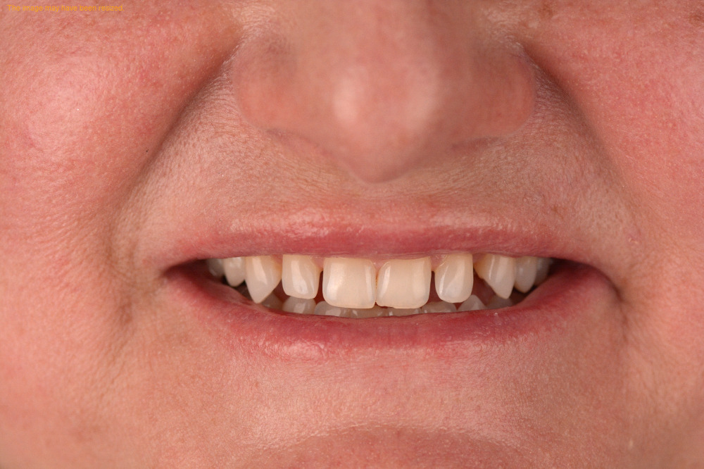 Smile Makeovers result, before
