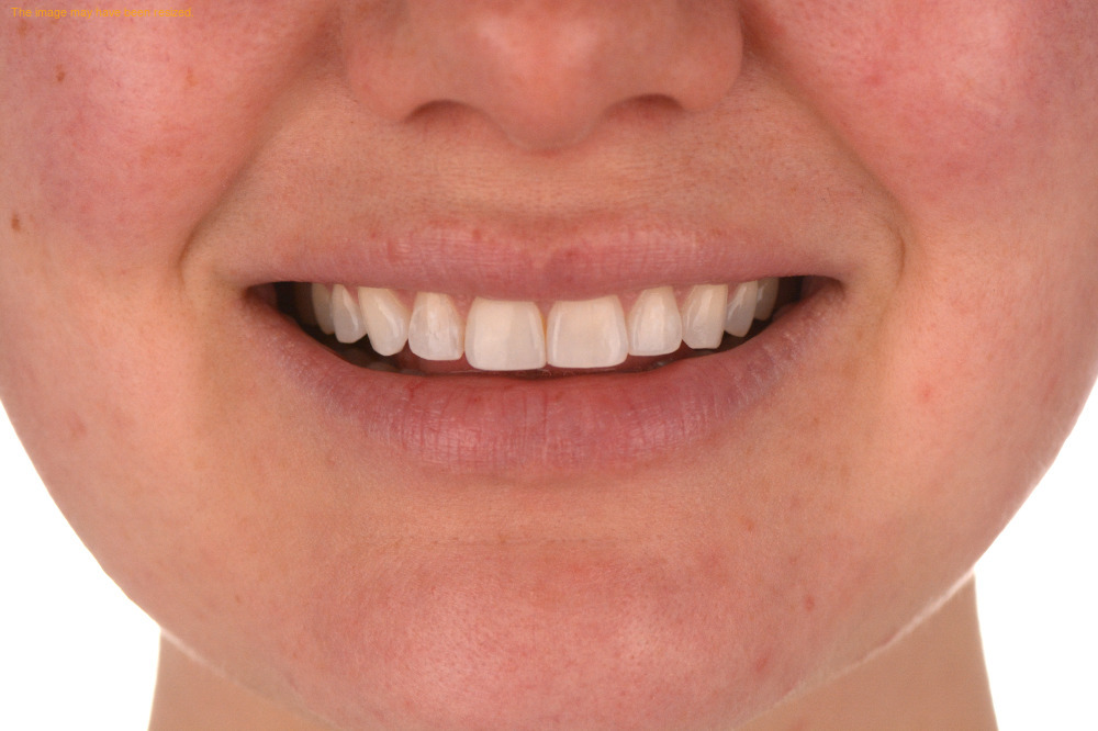 After Porcelain Veneers