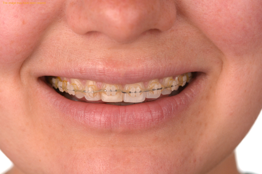 Before Porcelain Veneers