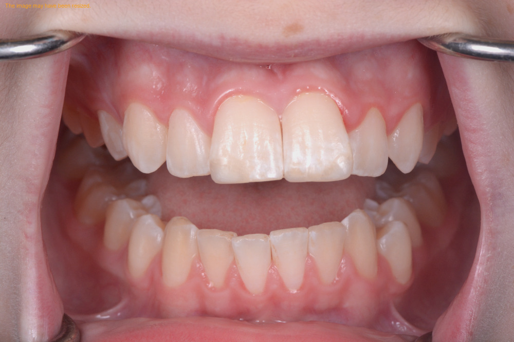 Smile Makeovers case 04, after