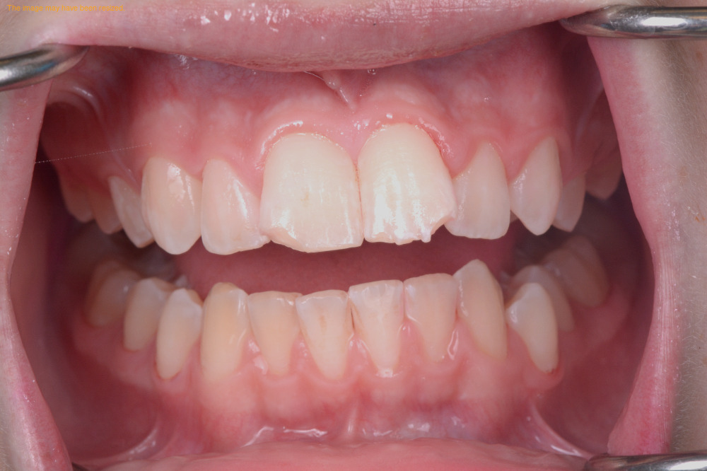 Smile Makeovers case 04, before