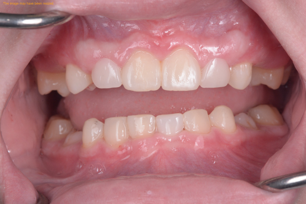 Smile Makeovers case 05, after