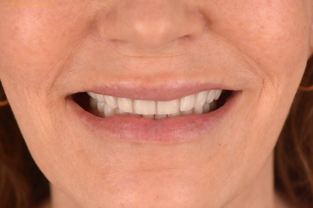 Smile Makeovers result, after