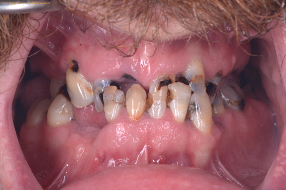 Smile Makeovers result, before