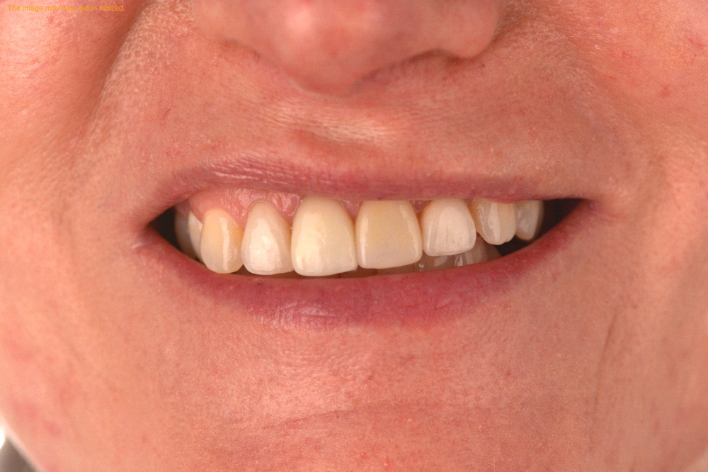 Smile Makeovers result, before