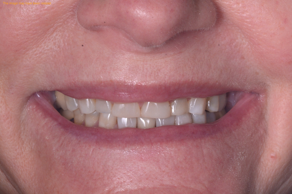 Smile Makeovers result, after