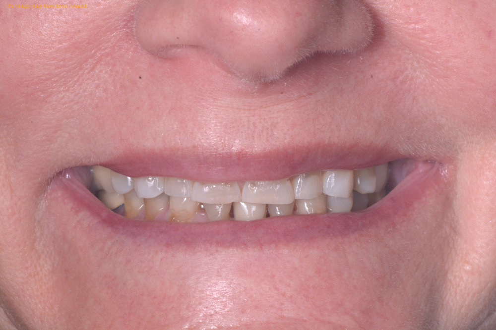 Smile Makeovers result, before