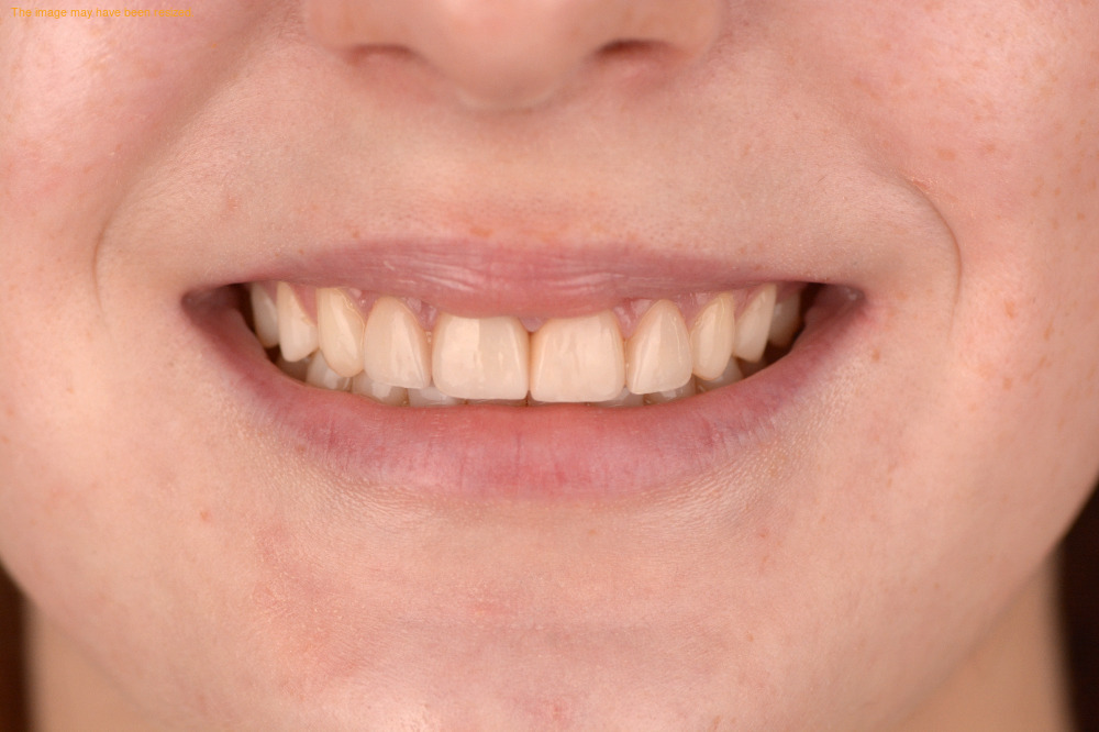 Smile Makeovers result, after
