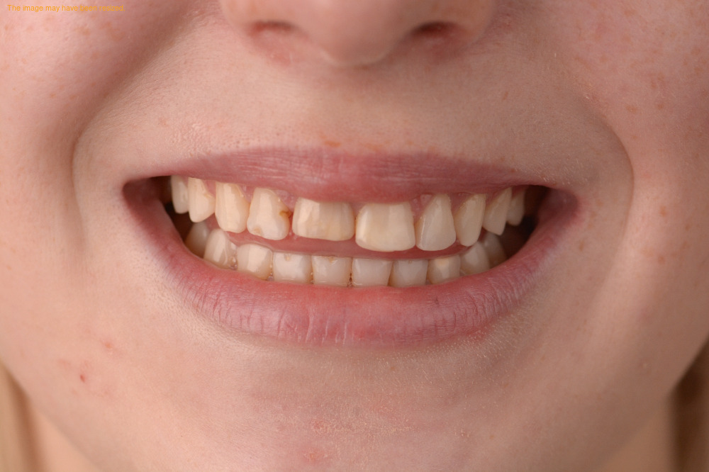 Smile Makeovers result, before