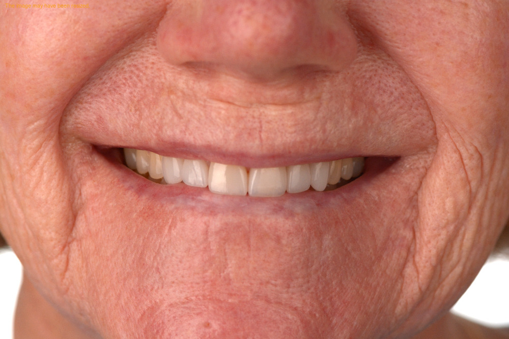 Smile Makeovers case 17, after