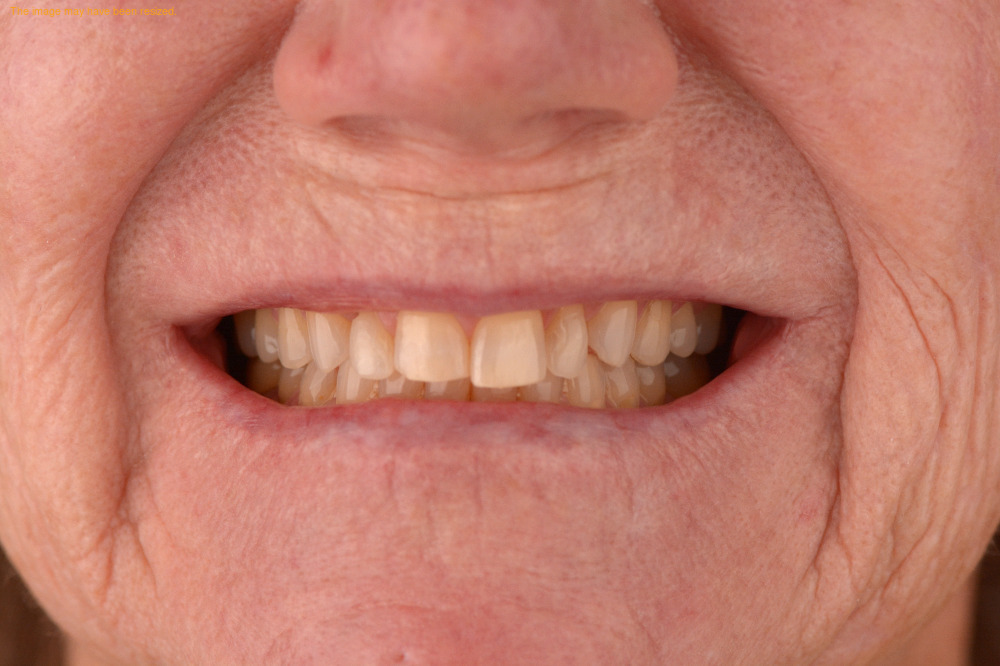 Smile Makeovers case 17, before