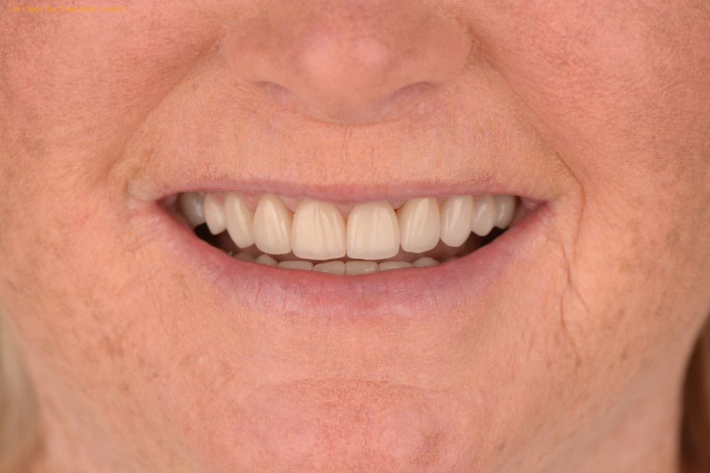 Smile Makeovers case 18, after