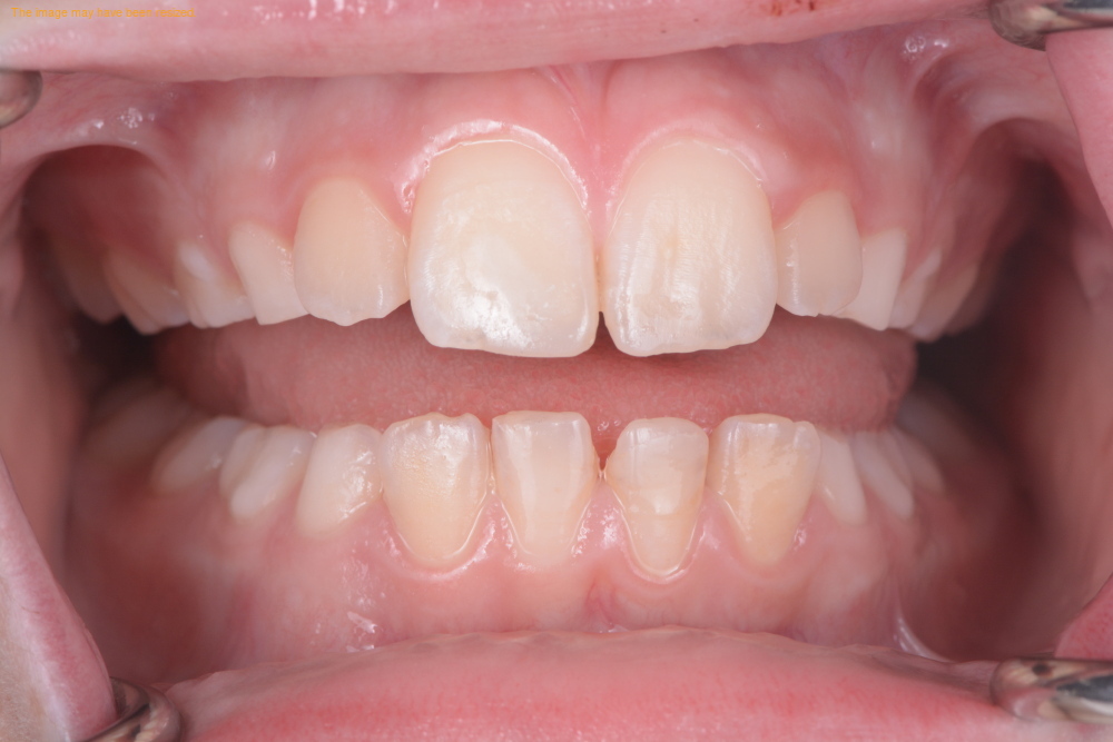 Smile Makeovers case 19, after