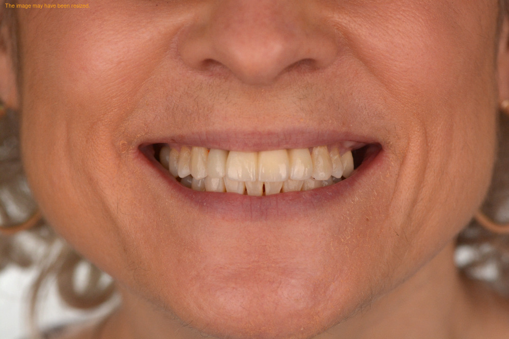 Tooth Replacement result, after