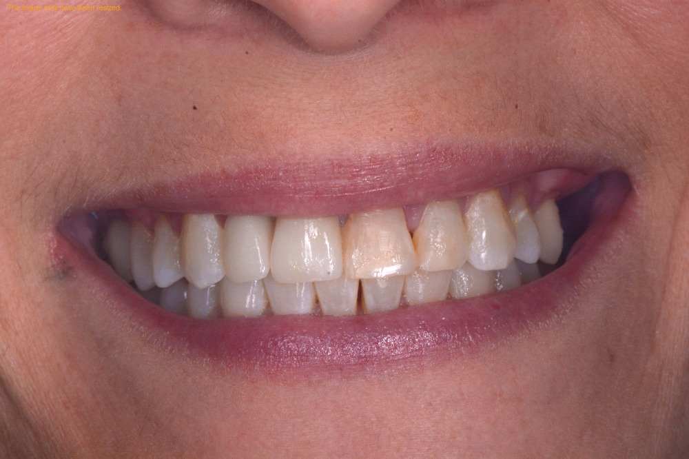 Tooth Replacement result, before