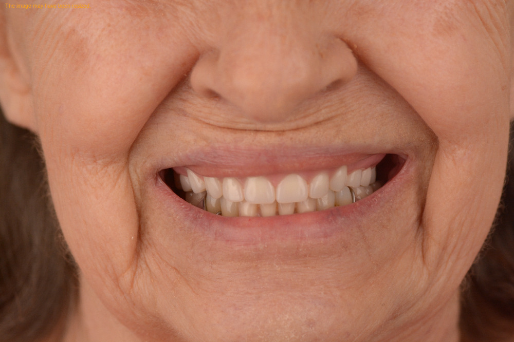 Tooth Replacement result, after