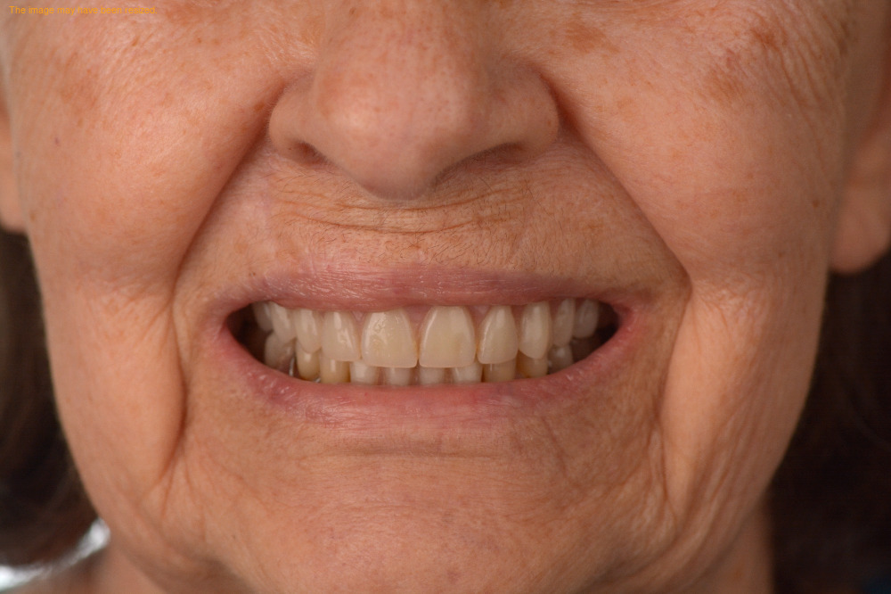 Tooth Replacement result, before